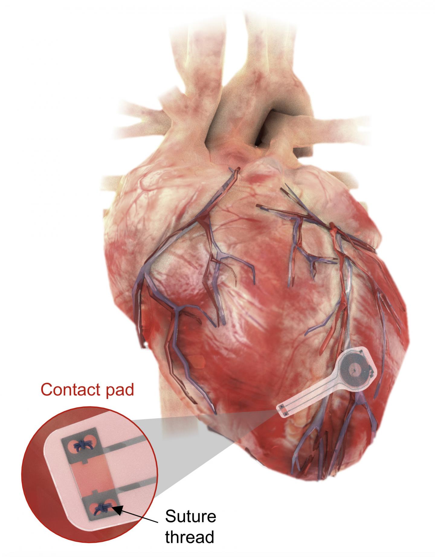 Device on heart