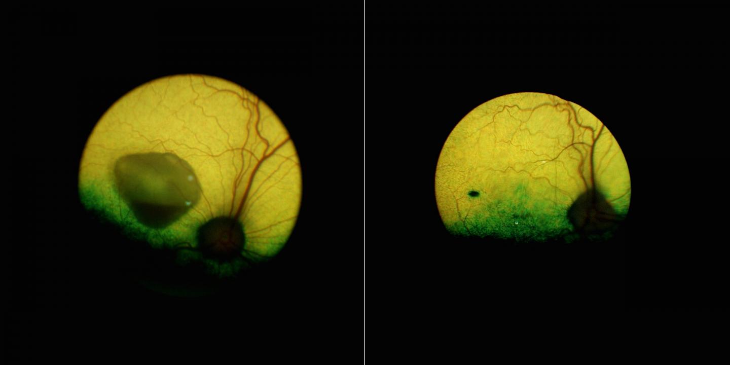 Eye, Before and after Gene Therapy