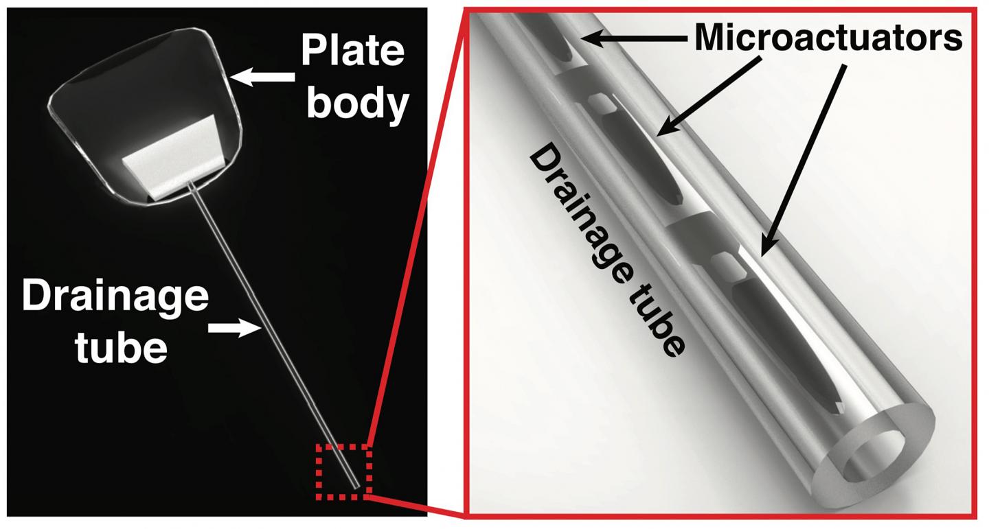 Purdue University Eye Drainage Device