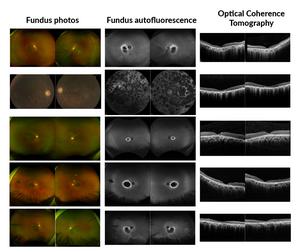 Ophthalmic imaging for the probands exhibiting variable forms of retinal dystrophy