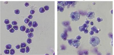 From Leukemia Cell to Normal Cell