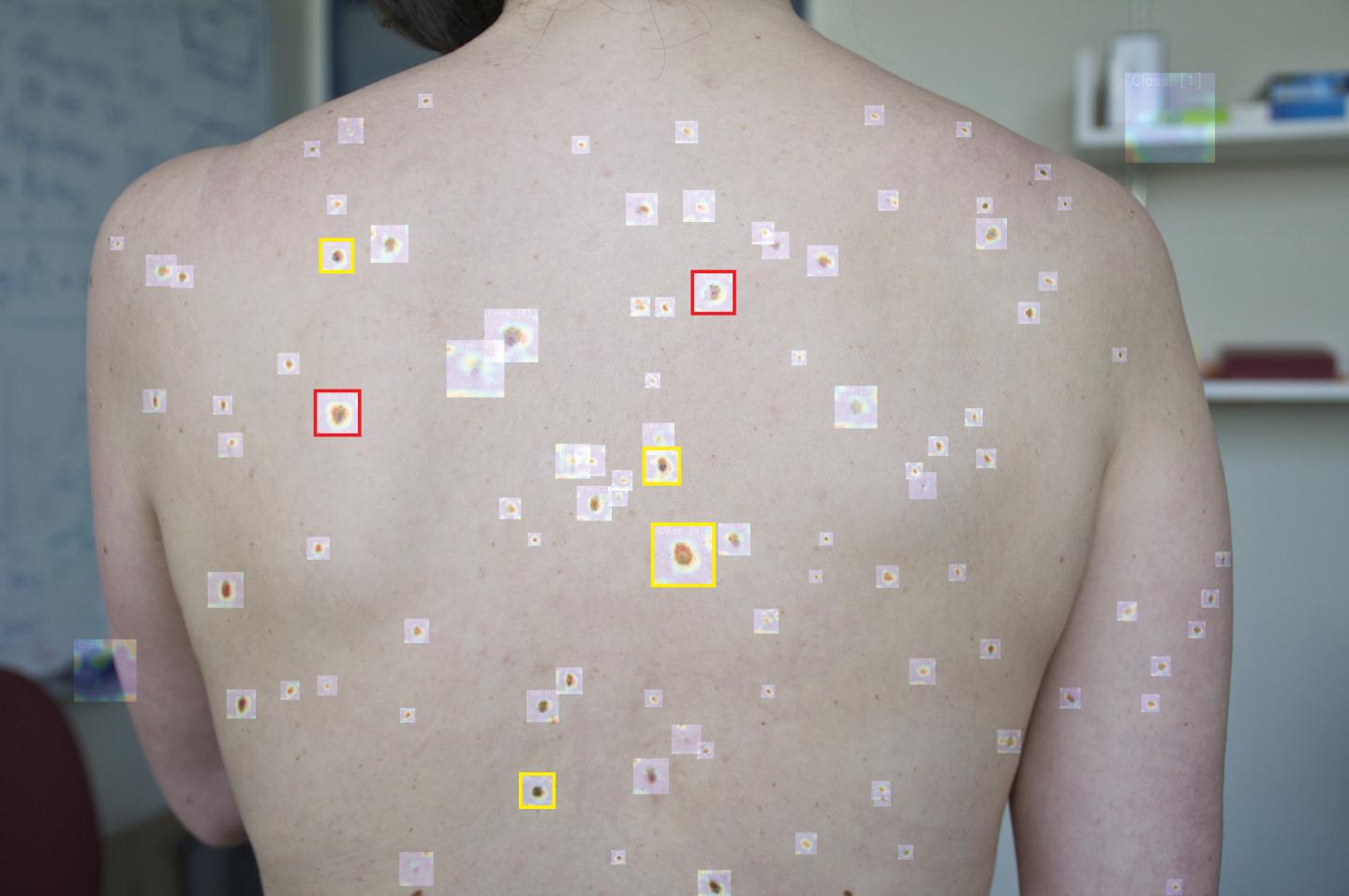 Neural Network Could Help Clinicians Look for "Ugly Duckling" Pre-Cancerous Skin Lesions (3 of 5)