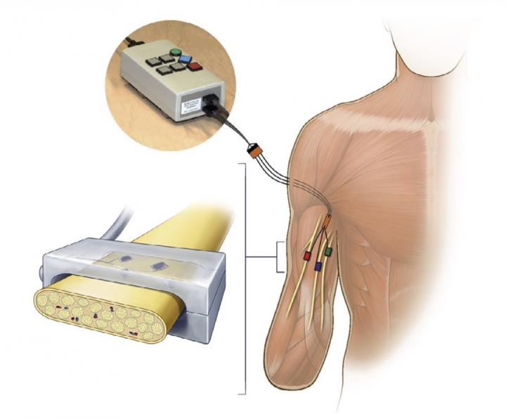 Implanted Peripheral Nerve Electrodes Deliver Stimulation Directly to the Nerve