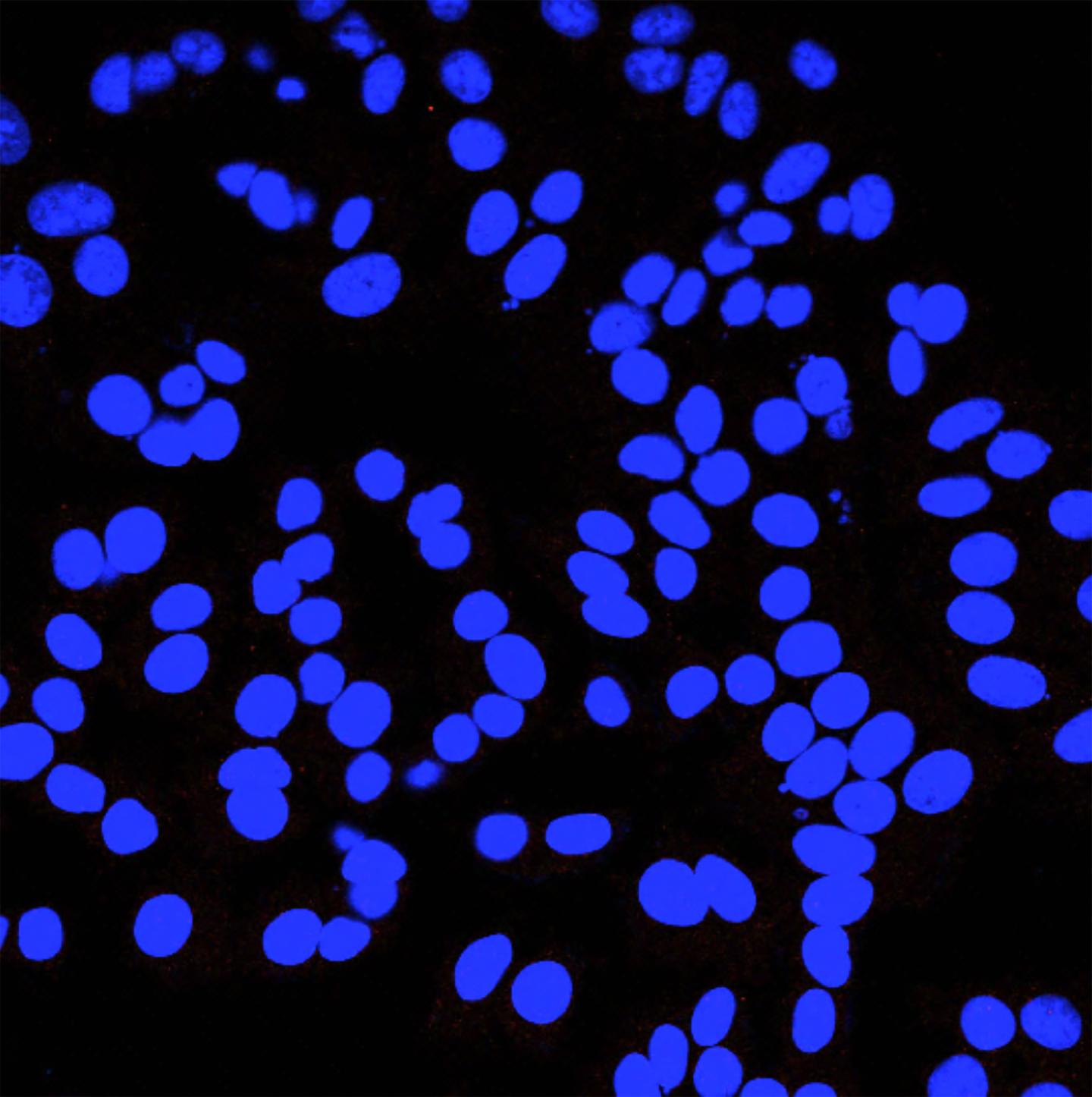 NUS Scientists Discover the 'Switch' that Makes Breast Cancer Cells Aggressive