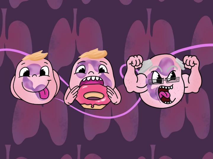 Tumor-associated neutrophils taking up glucose