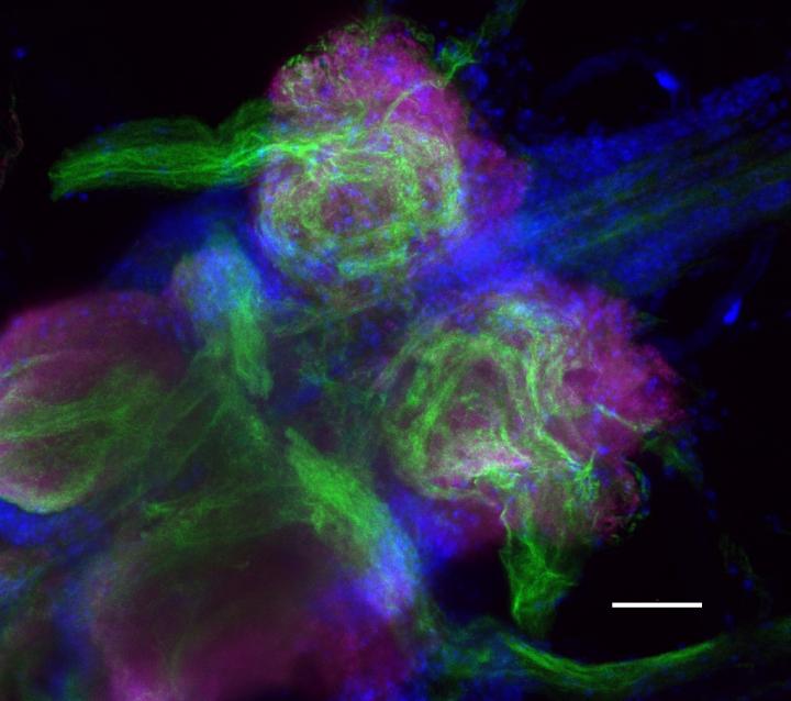 Gene that Protects against Heat-Induced Seizures in Fruit Flies May Explain Seizures in Humans