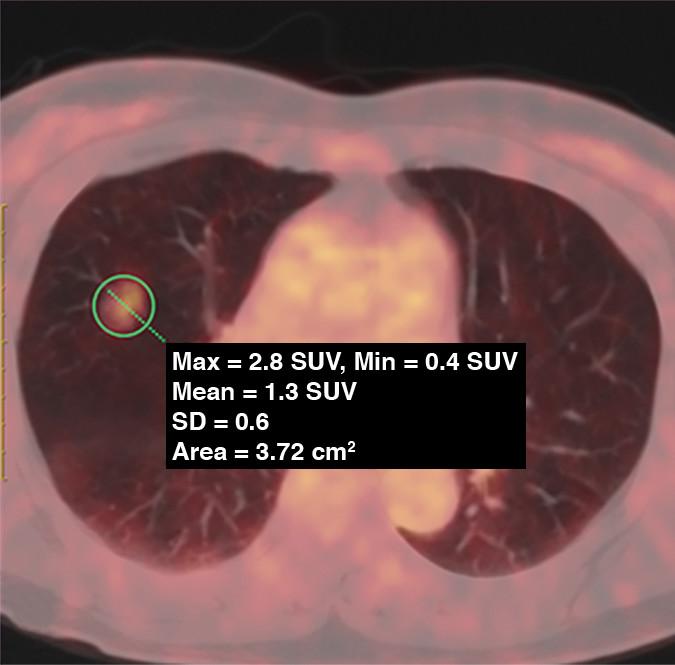 PET/CT plays role in lung adenocarcinoma mana EurekAlert!