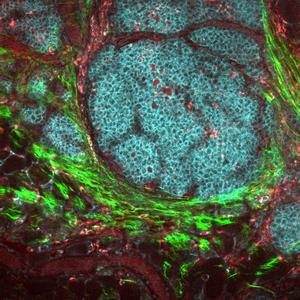 Multiphoton micrograph of breast cancer tumor from mouse