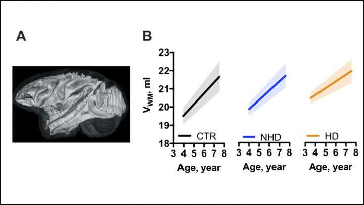 Ethanol & White Matter