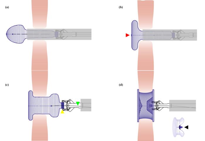 Illustration for the deployment and shaping process of the occluder.