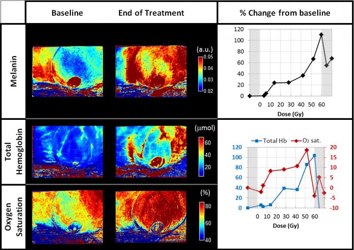 SFDIImages of Melanin, Total Hemoglobin and Oxygen Saturation of the Treated Breast