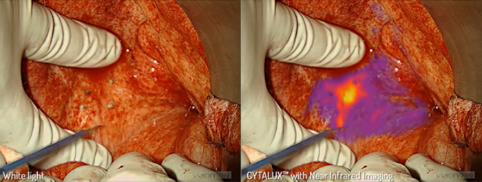 Illuminating Ovarian Tumors for Better Identification