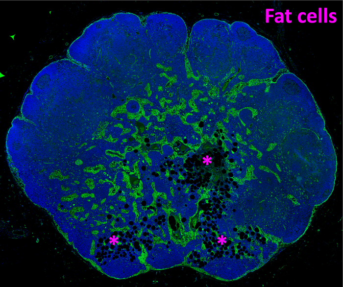 Early stage lipomatosis