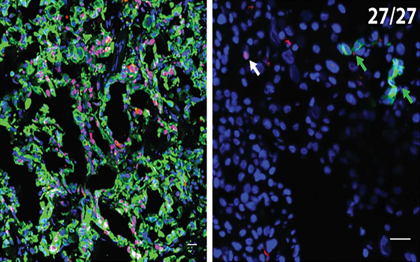 Dormant Seeds of Metastasis