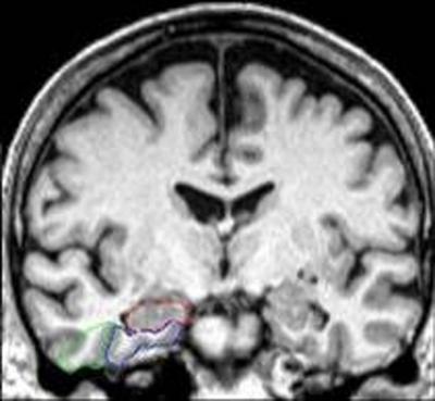 MRI Brain Scan Fig. 1