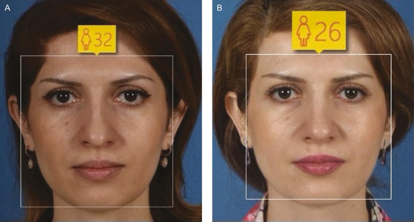 Study Participant --Before and After Rhinoplasty