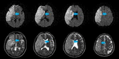 Diffusion-Weighted and T2-weighted MRIs