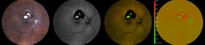 Eye exam (from left to right):