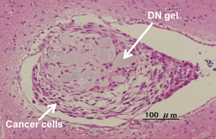 Tumor fomation in mice brain