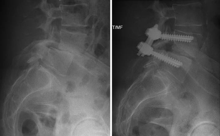 Awake Lumbar Interbody Fusion