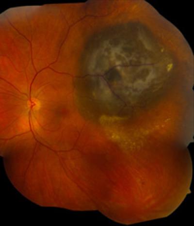 Gene in Eye Melanomas Linked to Good Prognosis