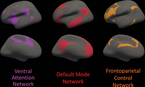 White Matter Integrity Disrupted in People with Alzheimer’s Gene Mutation