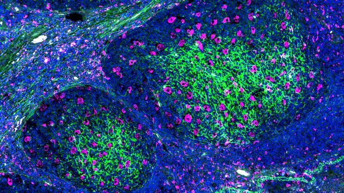 2024 0513 (CSI) Macrophages in lymphoma