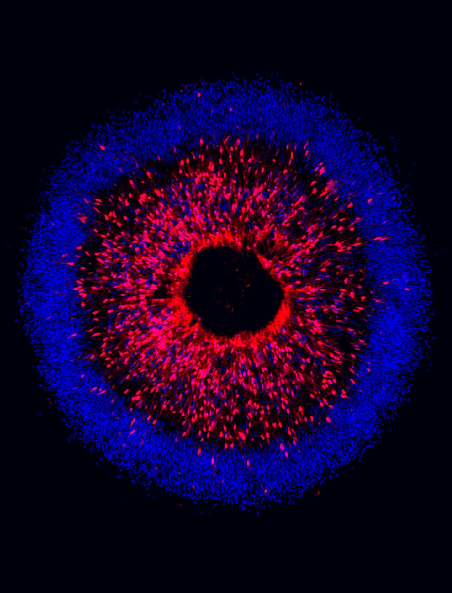 Human Stem Cells Modeled to Identify Degeneration in Glaucoma