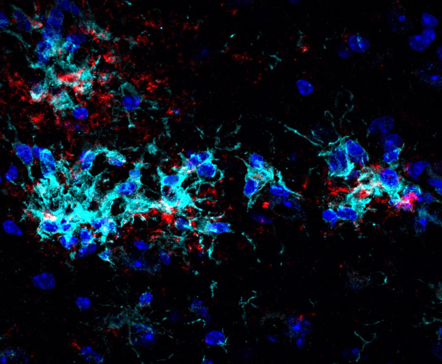 Mikroglia gathering around plaques