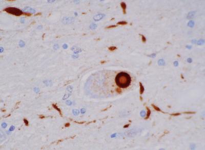 A Lewy Body Characteristic of Parkinson's Disease
