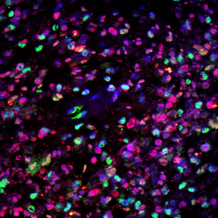 Glioblastoma under microscope with dyes.
