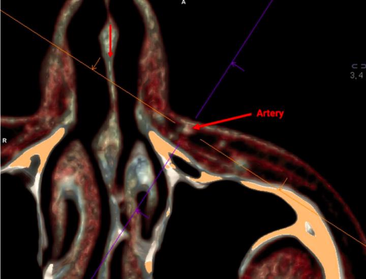 CT-Anatomy of the Facial Artery