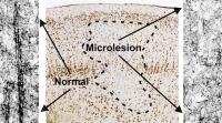 Microlesion
