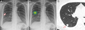 AI Improves Lung Nodule Detection on Chest X-rays