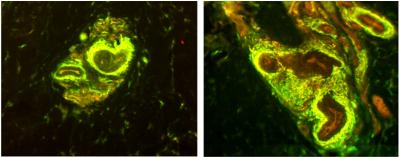 Sensory and Sympathetic Innervation to Arteriole-Venule Shunts in a Fibromyalgia Patient