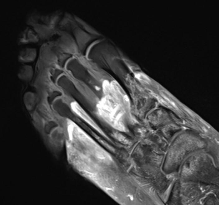 MRI image foot postCOVID [IMAGE] EurekAlert! Science News Releases