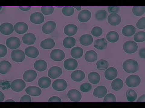 Abnormal Red Blood Cells Forming