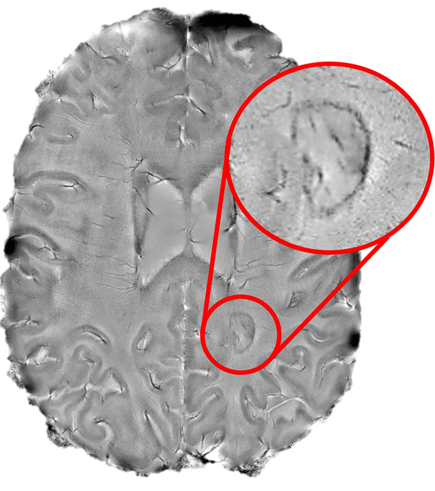 Smoldering Brain Spots and MS