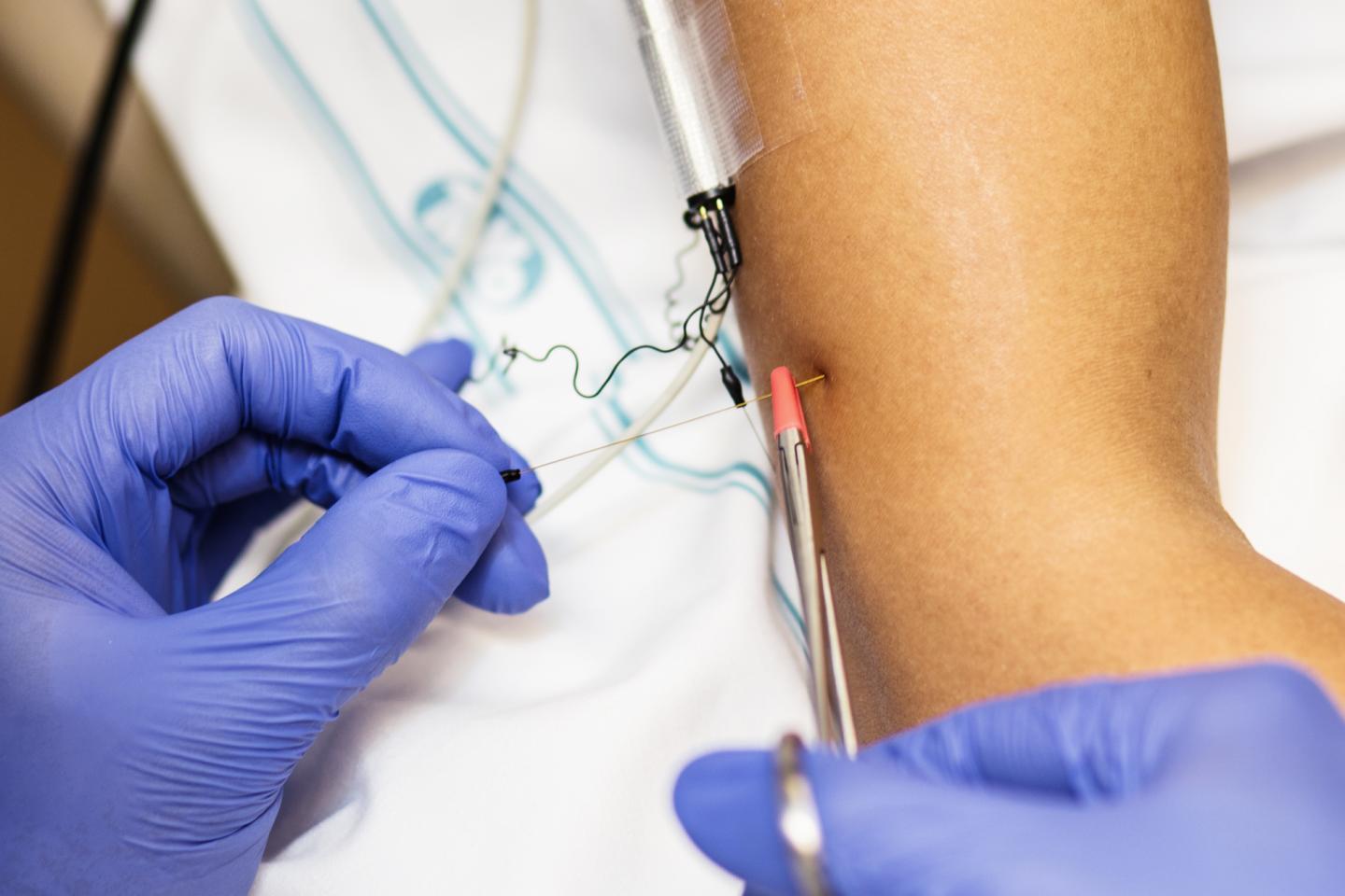 Rapid Pain Signaling (2 of 2)