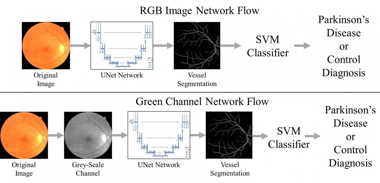 Eye Exam Could Lead to Early Parkinson's Disease Diagnosis