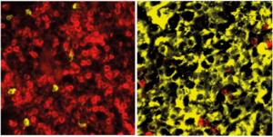 Multiple myeloma