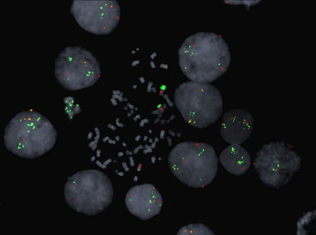 Chromosomes in Colon Cancer Cells Showing Multiple Copies of the BRAF Gene