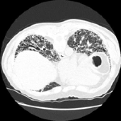 Lungs of an IPF Patient