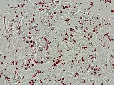 Lipid Droplets in Neuroblastoma
