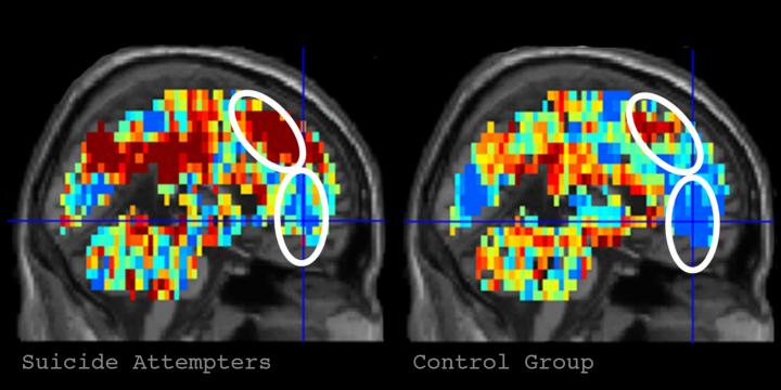 Brain Imaging Technology Identifies Individuals with Suicidal Thoughts
