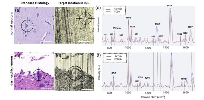 Raman spectroscopy distinguishes normal brain tissue from dysplastic tissue in single-cell analysis.