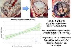 Study Finds Mechanical Valves Offer Superior Long-Term Survival for Aortic Valve Replacement Patients Aged 60 and Younger