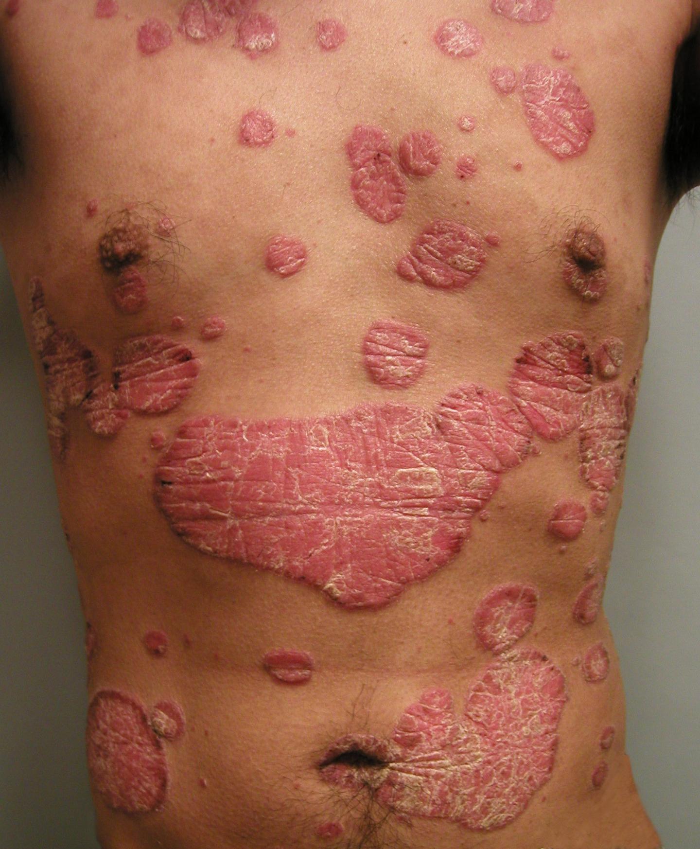 Severe Psoriasis