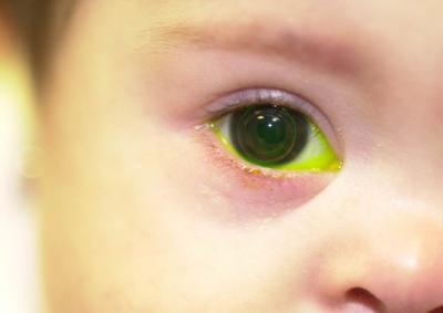 Child Wearing a Contact Lens