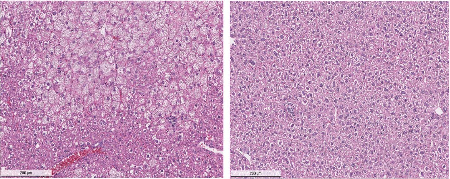 Reversing Liver Pathology in Wilson's Disease Model